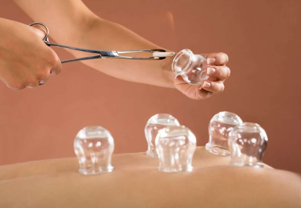 Cupping Therapy