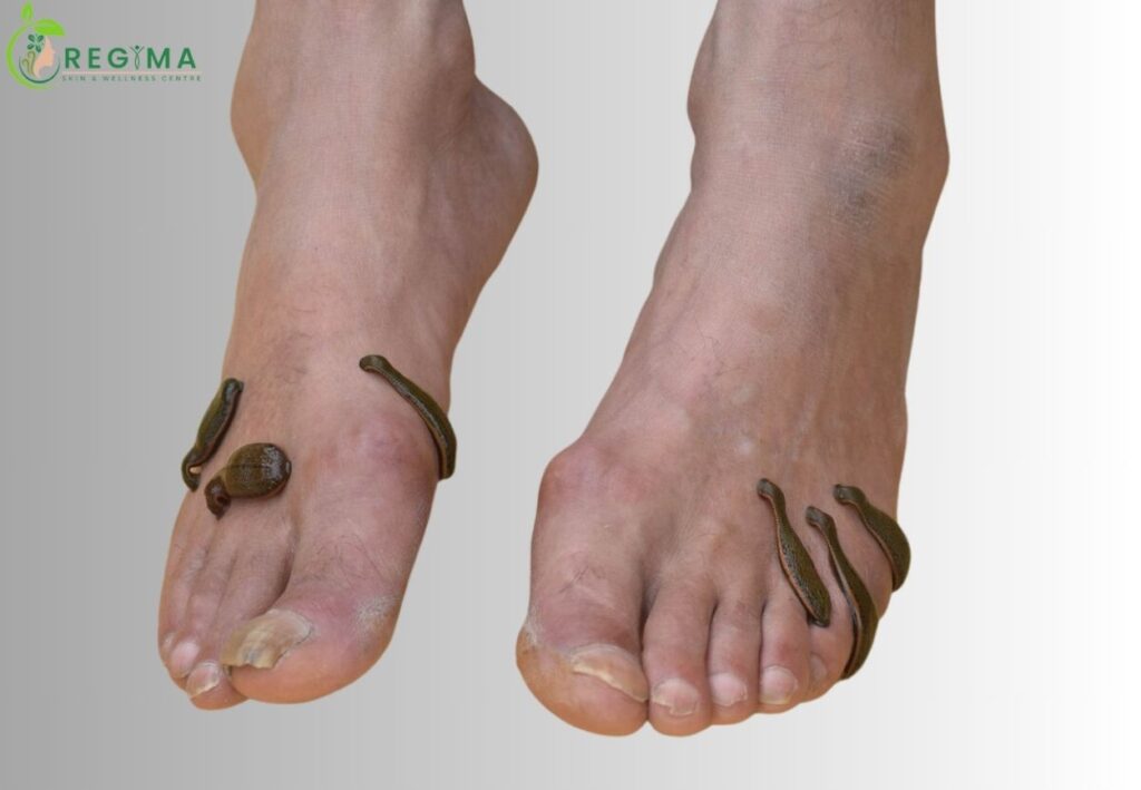 diabetic foot ulcer treatments in aligarh