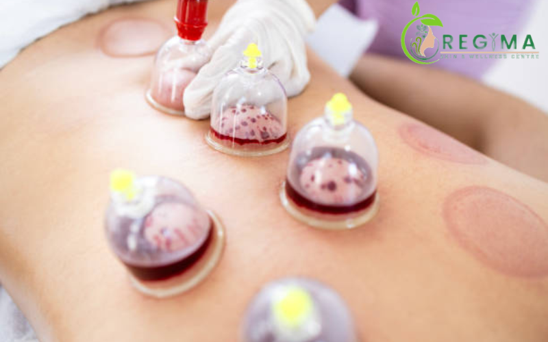 Best Hijama in Aligarh 1